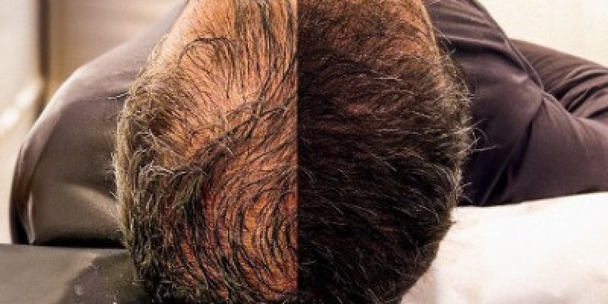 Revitalize Your Look with Hair Transplant in Islamabad