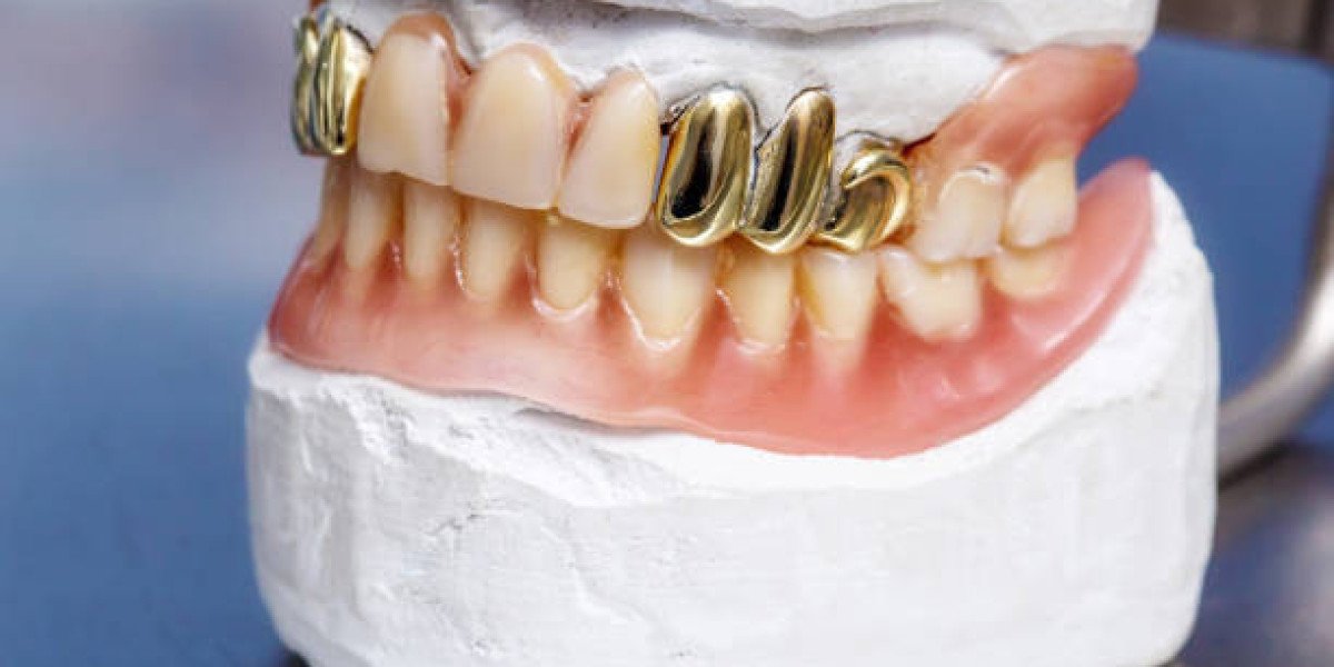 Gold Teeth: Aesthetic and Practical Guide