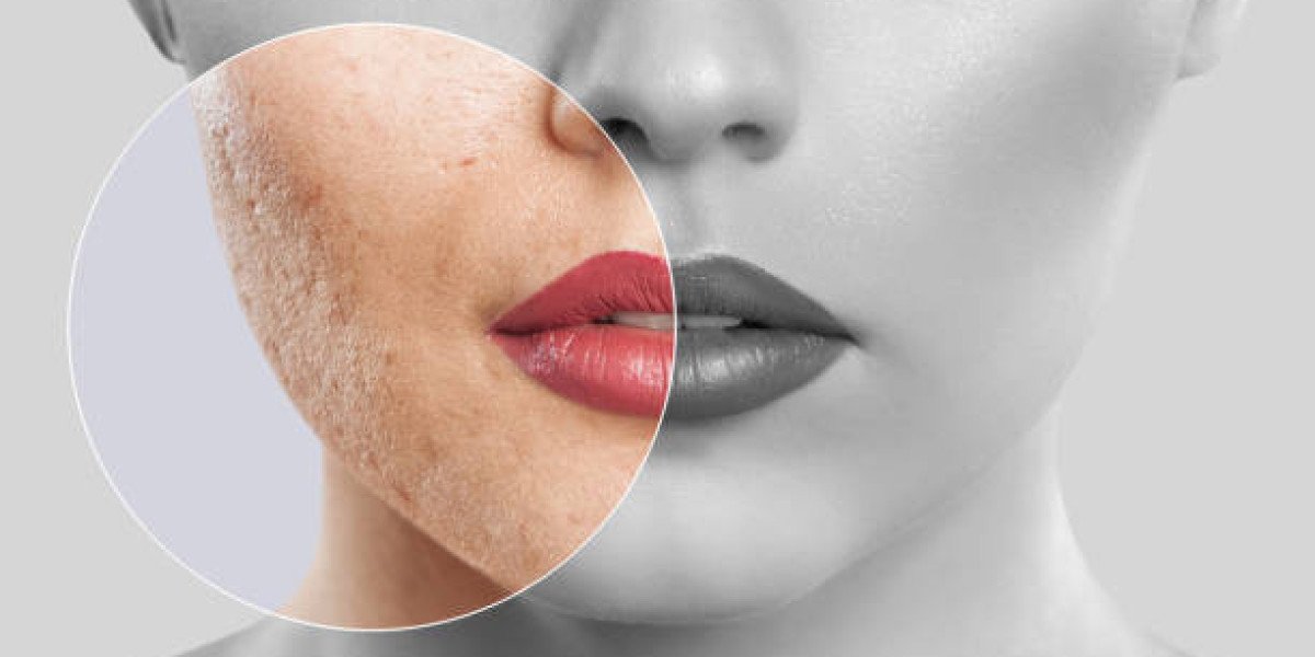 Laser Acne Treatment for Oily Skin Challenges